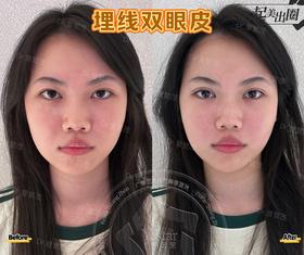 【曾繁茂】院长-埋线双眼皮案例