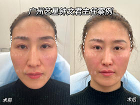 【钟文君】案例 气质蝴蝶面+外轮廓重塑