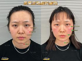 【王艳】院长-眼周年轻化＋中面部提升