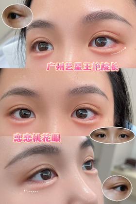 【王艳】院长-恋恋桃花眼案例对比