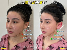 【王艳】院长-耳基底提升