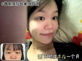 【曾繁茂】院长-双眼皮术后1个月反馈