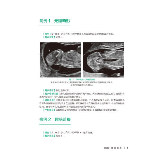 产科疾病超声图解100例 住院医师超声医学PBL教学培训系列教程 裴秋艳 汪龙霞 主编 全面阐述产科相关疾病 妇产科学人民卫生出版社 商品图4