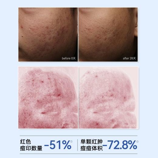 初尹8%壬二酸净颜精华20g 控油、祛痘、舒缓、敏感肌适用 商品图5