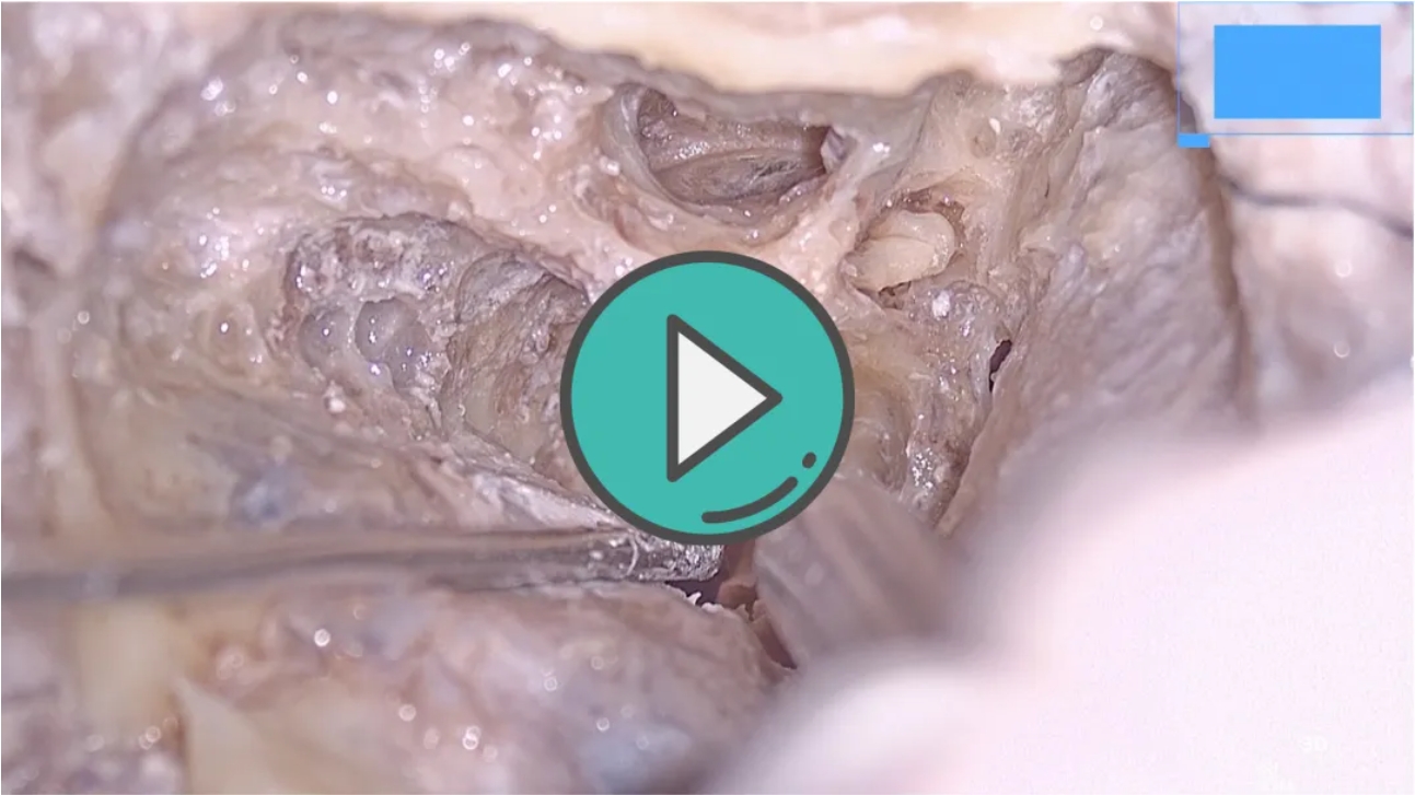 剪除前庭上、下神经， 进一步磨开内听道底部3D视频