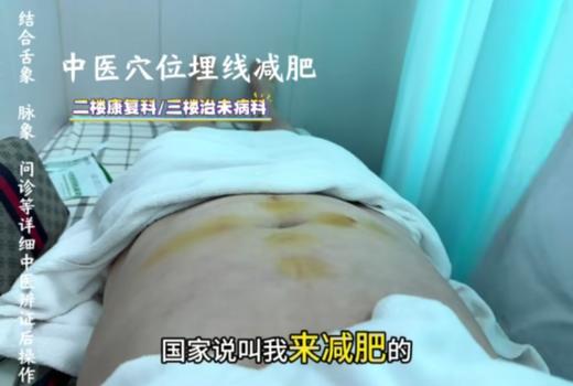 中医穴位埋线（仅到兴华社卫使用） 商品图1