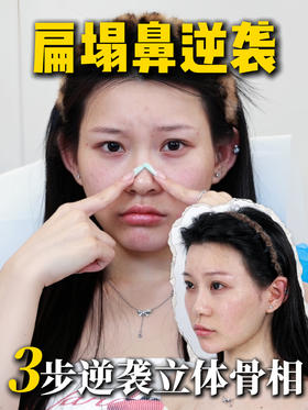 【种草王雯婷】扁塌鼻逆袭