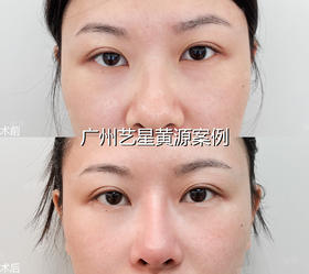 扁平塌鼻救星｜不叨叨快速get妈生直鼻