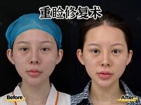 #广州艺星~眼修复 双眼皮不是越宽越好 假、宽、肌无力→妈生自然才是王道😆