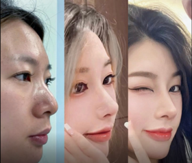 肉肉大头鼻➡高级立体鼻