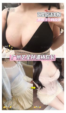 【艺星孙湄杨】舒适丰胸，三个月反馈