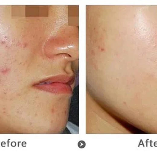 西班牙bcn积雪草修复水光2ml 修复改善肤质痘痘印 痘坑 商品图8