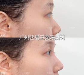 #广州艺星王雯婷院长【案例】