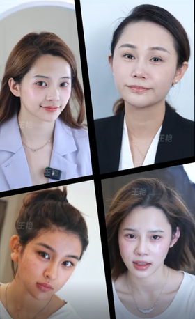 四位博主微整填充对比【王艳院长】