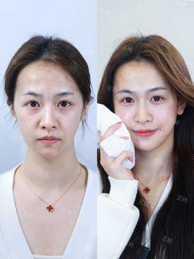 微整填充术前术后美丽对比【王艳院长】