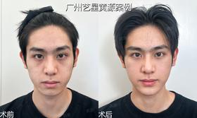 【黄源主任】微整调整案例