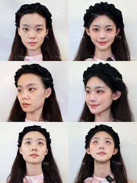 【王雯婷院长】肥肥六宫格美丽对比-微整填充