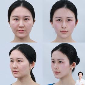 微整填充-精品案例【王雯婷院长微整】