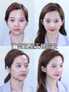 微整填充术前术后对比【王艳院长】