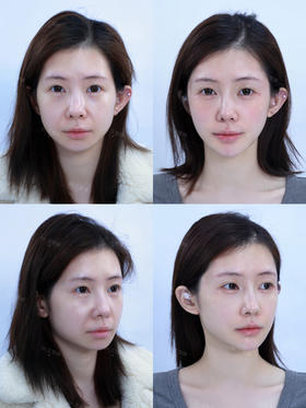 【王雯婷院长】微整填充-美丽对比