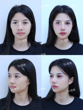 【黄源主任】微整填充美丽四宫图对比