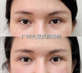 眼周抗衰保养| 年轻化思路 | 提升+支撑收紧