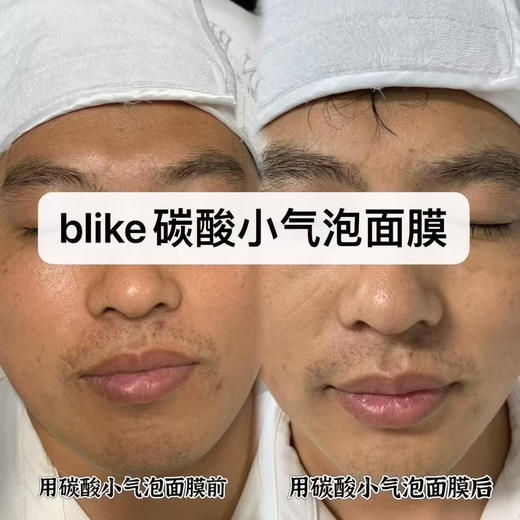 Blike碳酸净颜小气泡面膜50g 全脸清洁25分钟皮肤提亮三个度 黑头粉刺白头痘印 商品图3