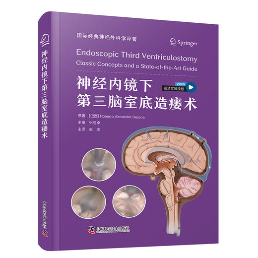 神经内镜下第三脑室底造瘘术 商品图0