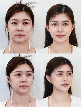 37岁宝妈轮廓提升