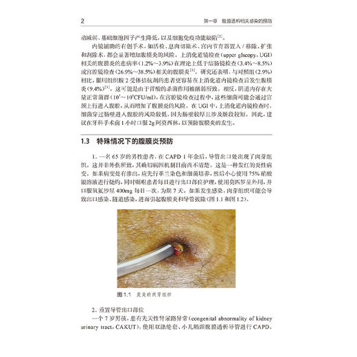 腹膜透析相关腹膜炎的诊治 徐岩 主译 全面介绍了成人及儿童腹膜透析相关腹膜炎的治疗时机 抗生素选择及给药方式等人民卫生出版社 商品图4