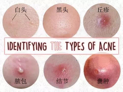 【泰国JXXINLIN·祛痘皮肤修护冷敷凝胶】祛痘救星，痘痘脸说拜拜~轻松搞定，温和不刺激 商品图4