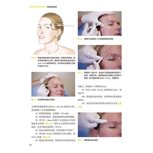 羟基磷灰石软组织填充剂 专家治疗技术 配视频 宋月星 李奕頲 林立荃 译 介绍了羟基磷灰石注射的步骤和技巧等 辽宁科学技术出版社 商品图4