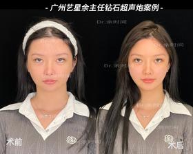 【余时间】主任钻石超声炮