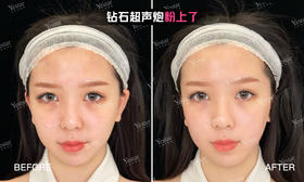 粉上砖石超声炮