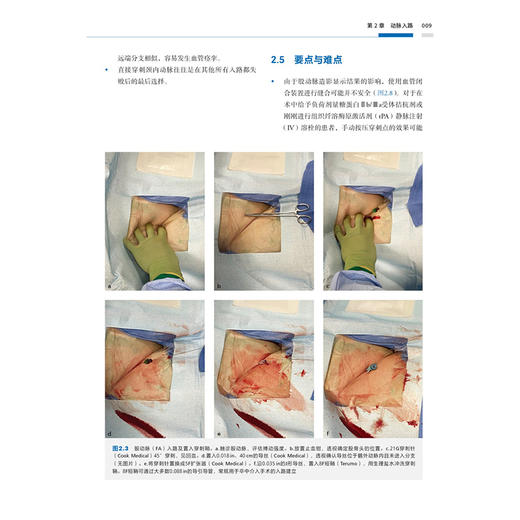 急性缺血性脑卒中介入治疗视频图谱 刘建民 杨鹏飞 张永巍 主译 临床神经影像学 辽宁科学技术出版社9787559140456 商品图4