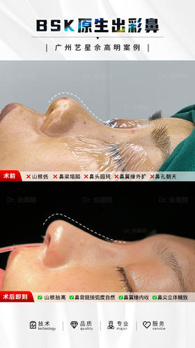 恰当的鼻部精雕 才能侧颜无敌☑