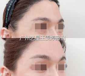 额头凹陷填充‼‼‼