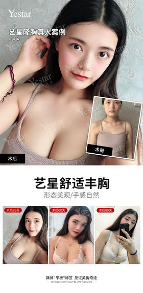 舒适丰胸&美力案例