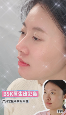 小姐姐鼻整形复诊日