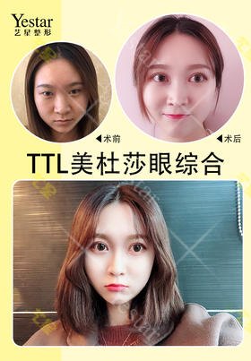 TTL美杜莎眼综合【曾繁茂院长】