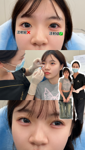 卧蚕术前术后对比【钟文君案例】