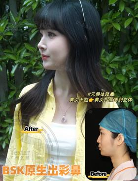 无假体隆鼻&术后返图