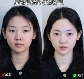 面部年轻化【钟文君主任】