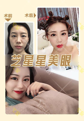 美眼术后返图对比【曾繁茂院长】