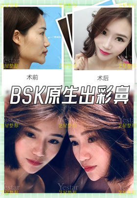 网红版（BSK宫廷半肋隆鼻）