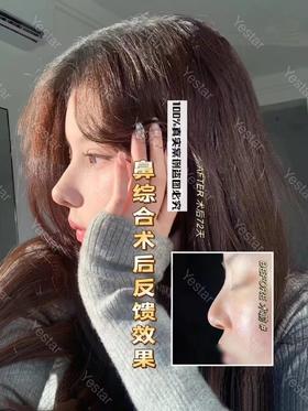 鼻综合术后反馈【佘高明】