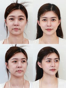 37岁宝妈轮廓提升