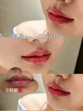 广州艺星kiss me口周年轻化对比