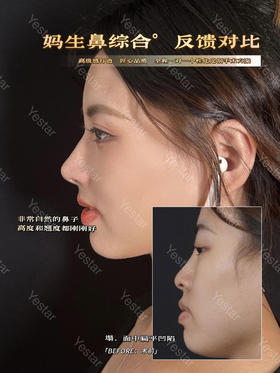 妈生鼻综合反馈对比【佘高明院长】