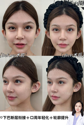 下巴断层衔接+口周年轻化+轮廓提升【钟文君主任】